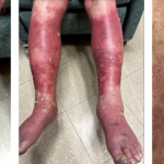 J&J vaccine causes mans skin to fall off