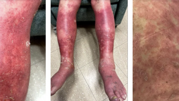 J&J vaccine causes mans skin to fall off