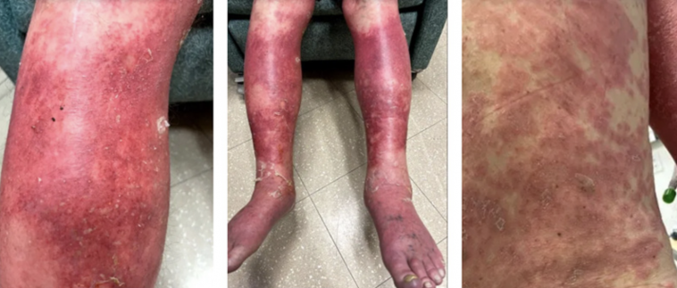 J&J vaccine causes mans skin to fall off