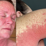 A mom in Scotland suffered a severe rash that covered her entire body shortly after receiving a Covid-19 vaccine.