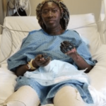 bilateral transtibial amputation from the Jab. When will this stop? Plandemic