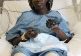 bilateral transtibial amputation from the Jab. When will this stop? Plandemic