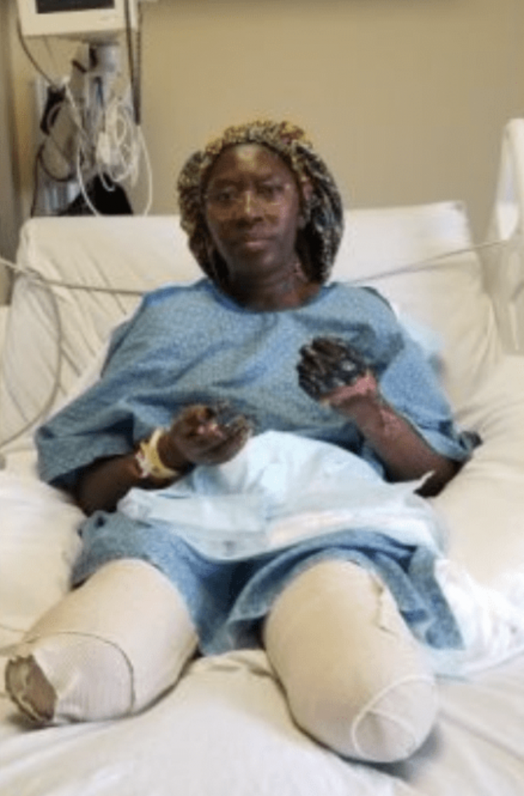 bilateral transtibial amputation from the Jab. When will this stop? Plandemic