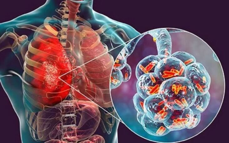 Bacterial Pneumonia Caused Most Deaths in 1918 Influenza Pandemic