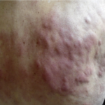 Angioimmunoblastic T Cell Lymphoma