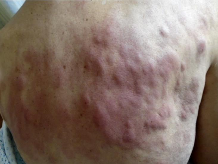 Angioimmunoblastic T Cell Lymphoma