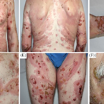 Autoimmune Bullous Dermatosis Following COVID-19 Vaccination A Series of Five Cases