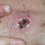 Chicago, Philadelphia, LA County record first monkeypox cases