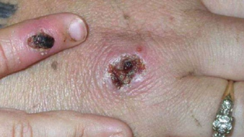 Chicago, Philadelphia, LA County record first monkeypox cases