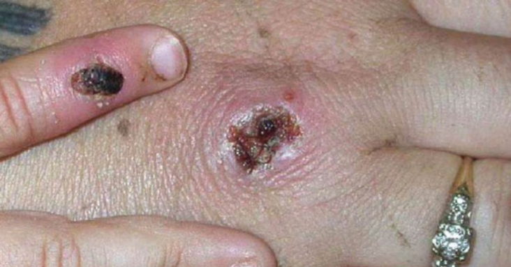 Chicago, Philadelphia, LA County record first monkeypox cases