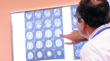 Bombshell Possible Fraudulent Images Used In Key Alzheimer’s Study Has Misled Research For Years, Report Says