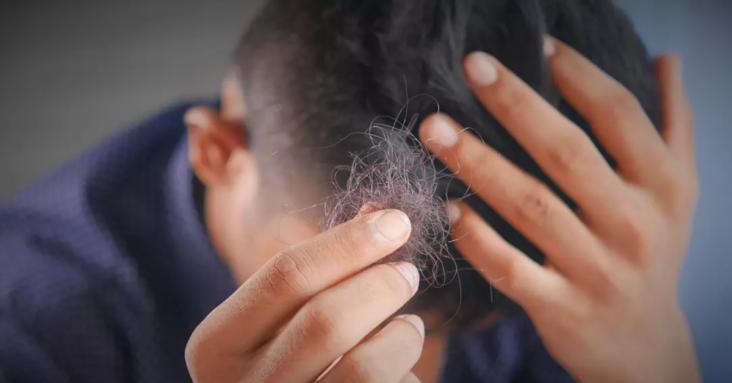 Long COVID: New study reveals more symptoms including hair loss and erectile dysfunction