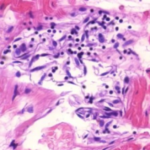 Vascular and organ damage induced by mRNA vaccines irrefutable proof of causality