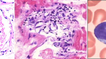 Vascular and organ damage induced by mRNA vaccines irrefutable proof of causality