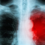 First Child Myocarditis Advertisement Airs: Is Myocarditis In Children Being Normalized?