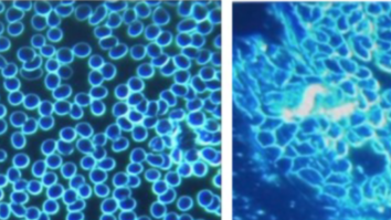 ‘Metal-Like Objects’ Found in 94 Percent of Group Who Had Symptoms After Taking mRNA Vaccines Study