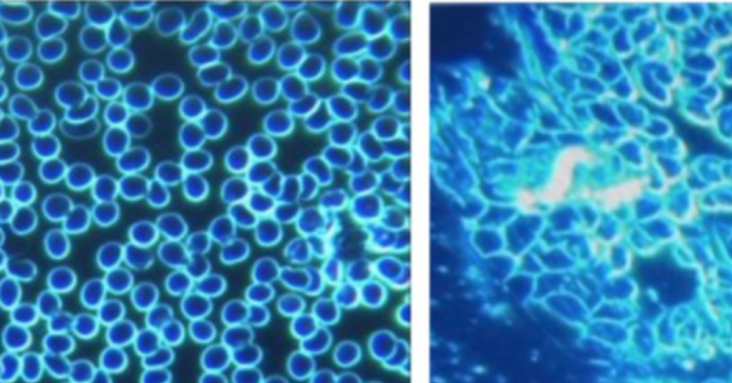 ‘Metal-Like Objects’ Found in 94 Percent of Group Who Had Symptoms After Taking mRNA Vaccines Study