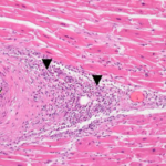 A Case Report Multifocal Necrotizing Encephalitis and Myocarditis after BNT162b2 mRNA Vaccination against COVID-19