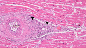 A Case Report Multifocal Necrotizing Encephalitis and Myocarditis after BNT162b2 mRNA Vaccination against COVID-19