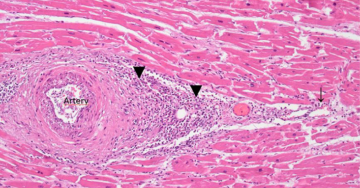 A Case Report Multifocal Necrotizing Encephalitis and Myocarditis after BNT162b2 mRNA Vaccination against COVID-19