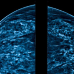 Inflamed Lymph Nodes, Bright Spots in Mammogram Following MRNA Vaccine