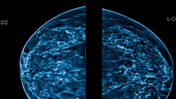 Inflamed Lymph Nodes, Bright Spots in Mammogram Following MRNA Vaccine