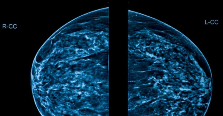 Inflamed Lymph Nodes, Bright Spots in Mammogram Following MRNA Vaccine