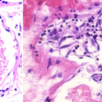 Vascular and organ damage induced by mRNA vaccines irrefutable proof of causality
