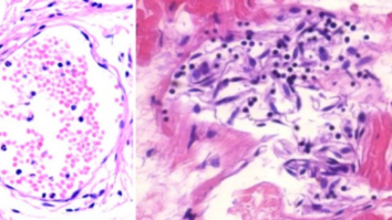 Vascular and organ damage induced by mRNA vaccines irrefutable proof of causality