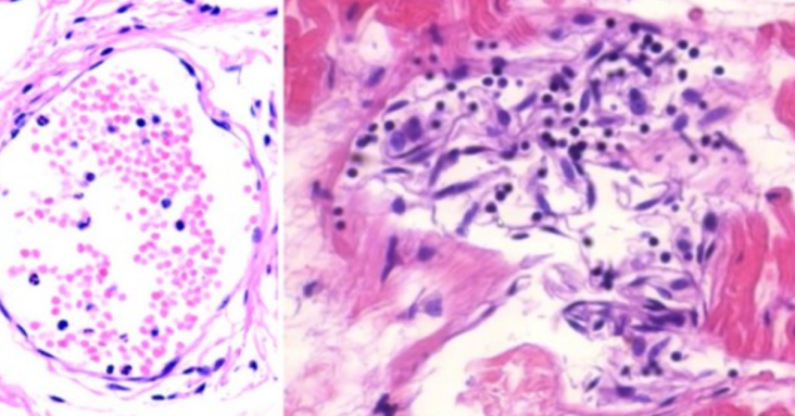 Vascular and organ damage induced by mRNA vaccines irrefutable proof of causality