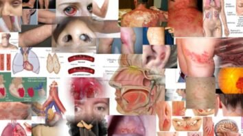 1000 peer reviewed articles on “Vaccine” injuries