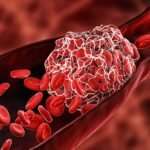 blood-clot-disorder