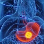 Doctors Warn of Mysterious Cancer ‘Epidemic’